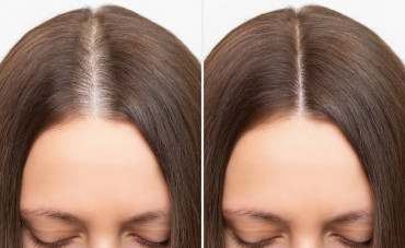 Hair loss remedies: what really works?