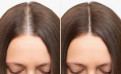 Hair loss remedies: what really works?